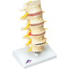 3B® Anatomical Model - Vertebrae Degeneration, Stages of Prolapsed Disc