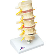 3B® Anatomical Model - Vertebrae Degeneration, Stages of Prolapsed Disc