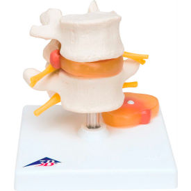 Fabrication Enterprises Inc 977726 3B® Anatomical Model - Lumbar Spinal Column with Prolapsed Intervertebral Disc image.