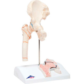 Fabrication Enterprises Inc 978091 3B® Anatomical Model - Femoral Fracture and Hip Osteoarthritis image.