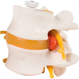 Fabrication Enterprises Inc 984665 3B® Anatomical Model - 2 Lumbar Vertebrae with Prolapsed Disc, Flexibly Mounted image.