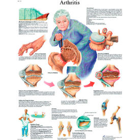 Fabrication Enterprises Inc 12-4605L 3B® Anatomical Chart - Arthritis, Laminated image.