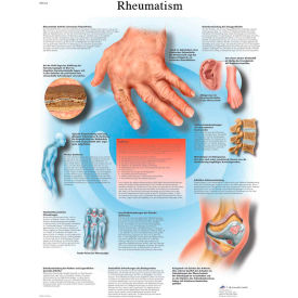 Fabrication Enterprises Inc 12-4618L 3B® Anatomical Chart - Rheumatic Diseases, Laminated image.