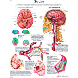 Fabrication Enterprises Inc 12-4629P 3B® Anatomical Chart - Stroke Chart Paper image.
