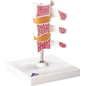 Fabrication Enterprises Inc 1062096 3B® Anatomical Model - Deluxe Osteoporosis (3 Vertebrae) image.