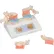 3B® Anatomical Model - Osteoporosis Model