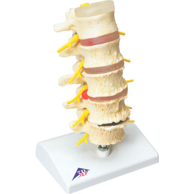 3B® Anatomical Model - Vertebrae Degeneration, Stages of Prolapsed Disc
