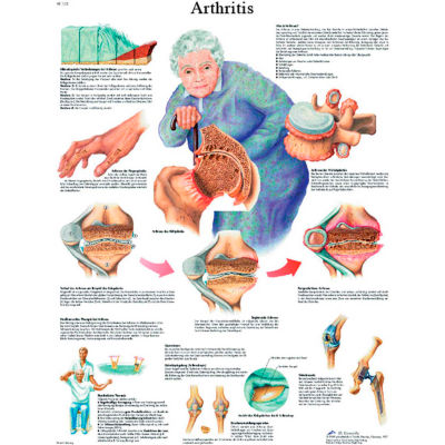 3B® Anatomical Chart - Arthritis, Laminated