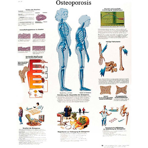 3B&#174; Anatomical Chart - Osteoporosis, Laminated